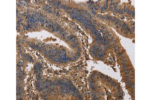 Immunohistochemistry of Human liver cancer using KCNG1 Polyclonal Antibody at dilution of 1:40