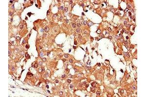 Immunohistochemistry of paraffin-embedded human breast cancer using ABIN7147342 at dilution of 1:100 (CRABP2 antibody  (AA 1-138))