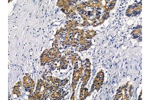 ABIN6258567 and ABIN6276236 at 1/100 staining human colorectal cancer by IHC-P.