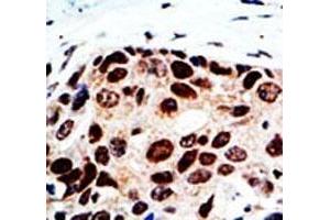 IHC analysis of FFPE human breast cancer tissue stained with the HDAC9 antibody (HDAC9 antibody  (AA 503-533))