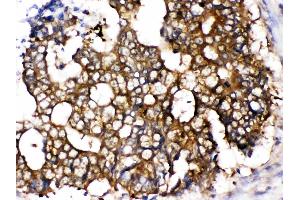 TCP1 epsilon was detected in paraffin-embedded sections of human intestinal cancer tissues using rabbit anti- TCP1 epsilon Antigen Affinity purified polyclonal antibody (Catalog # ) at 1 ? (CCT5 antibody  (AA 443-535))