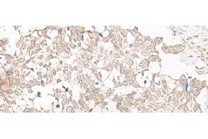 Immunohistochemistry of paraffin-embedded Human lung cancer tissue using ESPN Polyclonal Antibody at dilution of 1:25(x200) (Espin antibody)