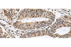 Immunohistochemistry of paraffin-embedded Human colorectal cancer tissue using TMX3 Polyclonal Antibody at dilution of 1:70(x200) (TMX3 antibody)