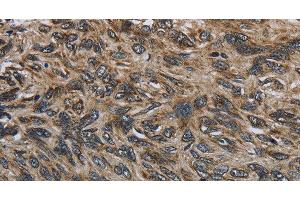 Immunohistochemistry of paraffin-embedded Human esophagus cancer tissue using CD236 Polyclonal Antibody at dilution 1:60 (CD236/GYPC antibody)