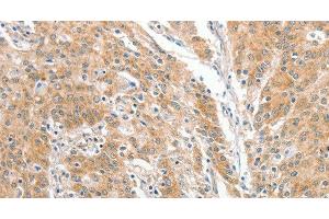 Immunohistochemistry of paraffin-embedded Human gastric cancer using COL4A3BP Polyclonal Antibody at dilution of 1:60 (COL4A3BP antibody)
