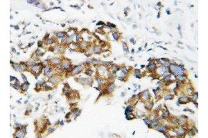 Anti-Superoxide Dismutase 1 antibody, IHC(P) IHC(P): Human Mammary Cancer Tissue (SOD1 antibody  (C-Term))