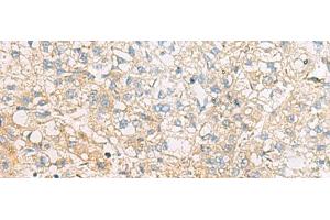 Immunohistochemistry of paraffin-embedded Human liver cancer tissue using EIF4E2 Polyclonal Antibody at dilution of 1:50(x200) (EIF4E2 antibody)