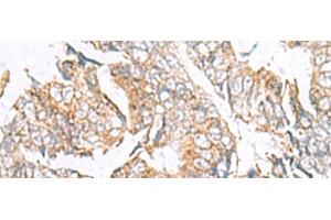 Immunohistochemistry of paraffin-embedded Human colorectal cancer tissue using GPC2 Polyclonal Antibody at dilution of 1:40(x200) (GPC2 antibody)