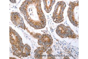 Immunohistochemistry of Human liver cancer using HCRTR1 Polyclonal Antibody at dilution of 1:70 (HCRTR1 antibody)