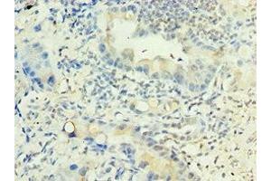 Immunohistochemistry of paraffin-embedded human lung cancer using ABIN7158043 at dilution of 1:100 (LRG1 antibody  (AA 36-347))