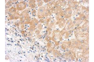 IHC-P Image Immunohistochemical analysis of paraffin-embedded human hepatoma, using C5 antibody, antibody at 1:500 dilution. (C5 antibody  (C-Term))