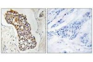 Immunohistochemistry analysis of paraffin-embedded human breast carcinoma tissue, using HSD11B1 antibody. (HSD11B1 antibody  (N-Term))