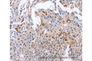 Immunohistochemistry of Human cervical cancer using NRG4 Polyclonal Antibody at dilution of 1:60 (Neuregulin 4 antibody)