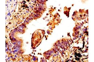 IHC image of ABIN7148983 diluted at 1:400 and staining in paraffin-embedded human lung cancer performed on a Leica BondTM system. (CSTA antibody  (AA 2-98))