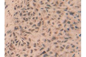 DAB staining on IHC-P; Samples: Human Lung cancer Tissue (TRAF5 antibody  (AA 181-437))