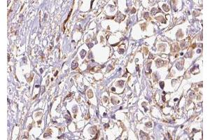 ABIN6277603 at 1/100 staining Human breast cancer tissue by IHC-P. (PEX19 antibody  (Internal Region))