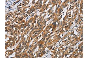 The image on the left is immunohistochemistry of paraffin-embedded Human esophagus cancer tissue using ABIN7190509(DSP Antibody) at dilution 1/40, on the right is treated with synthetic peptide. (Desmoplakin antibody)