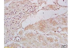 Formalin-fixed and paraffin embedded human gastric carcinoma labeled with Anti Tbx21/T-bet Polyclonal Antibody, Unconjugated (ABIN701395) at 1:200 followed by conjugation to the secondary antibody and DAB staining. (T-Bet antibody)