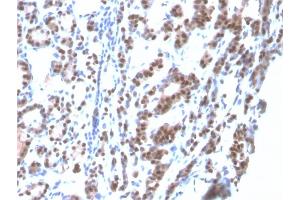 Formalin-fixed, paraffin-embedded human Thyroid stained with TTF-1 Mouse Recombinant Monoclonal Antibody (rNX2. (Recombinant NKX2-1 antibody)