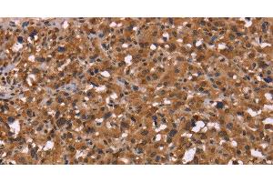 Immunohistochemistry of paraffin-embedded Human thyroid cancer using HDLBP Polyclonal Antibody at dilution of 1:50 (HDLBP antibody)