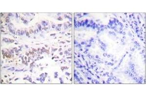 Immunohistochemistry analysis of paraffin-embedded human lung carcinoma tissue, using XRCC3 Antibody. (RCC3 (AA 41-90) antibody)