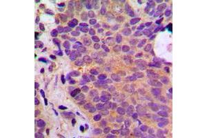 Immunohistochemical analysis of ADPGK staining in human breast cancer formalin fixed paraffin embedded tissue section. (ADPGK antibody  (Center))