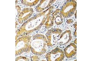 Immunohistochemical analysis of AGXT2L2 staining in human colon cancer formalin fixed paraffin embedded tissue section. (AGXT2L2 antibody  (C-Term))