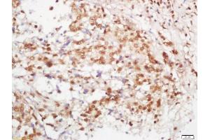 Formalin-fixed and paraffin embedded human lung carcinoma labeled with Rabbit Anti-B MyB Polyclonal Antibody, Unconjugated (ABIN760406) at 1:200 followed by conjugation to the secondary antibody and DAB staining (MYBL2 antibody  (AA 101-200))