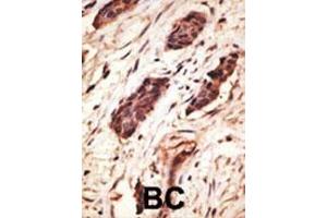 Formalin-fixed and paraffin-embedded human cancer tissue reacted with the primary antibody, which was peroxidase-conjugated to the secondary antibody, followed by DAB staining. (MMP10 antibody  (C-Term))