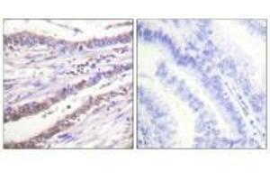 Immunohistochemical analysis of paraffin-embedded human lung carcinoma tissue using Cyclin A antibody.