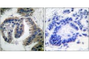 Immunohistochemistry analysis of paraffin-embedded human lung carcinoma tissue, using HSP40 Antibody. (DNAJB1 antibody  (AA 271-320))