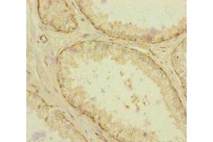 Immunohistochemistry of paraffin-embedded human prostate cancer using ABIN7167234 at dilution of 1:100 (RAB18 antibody  (AA 1-206))