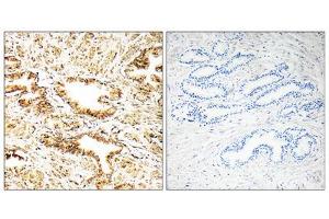 Immunohistochemistry analysis of paraffin-embedded human prostate carcinoma tissue, using CAMKK2 antibody. (CAMKK2 antibody  (Internal Region))