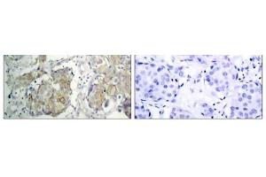 Immunohistochemical analysis of paraffin-embedded human breast carcinoma tissue, using V (VEGFR2/CD309 antibody  (pTyr1214))