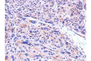 IHC-P Image CBR1 antibody [C2C3], C-term detects CBR1 protein at cytosol on human hepatoma by immunohistochemical analysis. (CBR1 antibody  (C-Term))