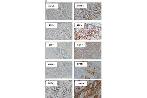 Immunostaining of EGFR ligands and co-expression with wtEGFR in mCRC specimensExpression of Amphiregulin, BTC, EGF, Epigen, and TGFα (A), and co-expression of wtEGFR, Amphiregulin, BTC, EGF, epigen, and TGFα in a particular patient (B) in formalin fixed paraffin embedded tumour sections stained immunohistochemically as described under methods and patients section. (Amphiregulin antibody)