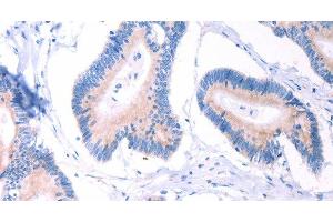 Immunohistochemistry of paraffin-embedded Human colon cancer using AADAC Polyclonal Antibody at dilution of 1:30 (AADAC antibody)