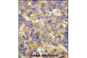 Formalin-fixed and paraffin-embedded human breast carcinoma tissue reacted with DKK3 Antibody (N-term), which was peroxidase-conjugated to the secondary antibody, followed by DAB staining. (DKK3 antibody  (N-Term))