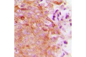 Immunohistochemical analysis of MRRF staining in human breast cancer formalin fixed paraffin embedded tissue section. (MRRF antibody  (C-Term))