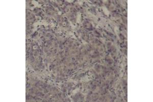 Immunohistochemistry of paraffin-embedded human breast carcinoma using Phospho-CREB1-S142 antibody (ABIN2987965). (CREB1 antibody  (pSer142))
