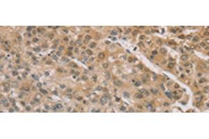 Immunohistochemistry of paraffin-embedded Human liver cancer tissue using ZIC2 Polyclonal Antibody at dilution of 1:100(x200) (ZIC2 antibody)