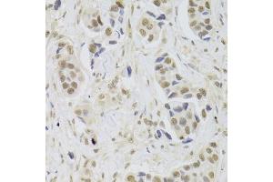 Immunohistochemistry of paraffin-embedded human breast cancer using UBE3C Antibody. (UBE3C antibody)