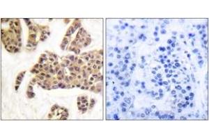 Immunohistochemistry analysis of paraffin-embedded human breast carcinoma, using BAD (Phospho-Ser91/128) Antibody. (BAD antibody  (pSer91))