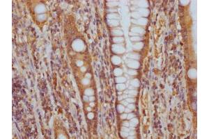 IHC image of ABIN7127577 diluted at 1:100 and staining in paraffin-embedded human colon cancer performed on a Leica BondTM system. (Recombinant CD51 antibody)