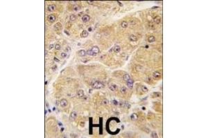 Formalin-fixed and paraffin-embedded human hepatocarcinoma tissue reacted with SOST antibody (Center) (ABIN390194 and ABIN2840683) , which was peroxidase-conjugated to the secondary antibody, followed by DAB staining. (Sclerostin antibody  (AA 134-163))