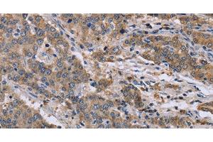 Immunohistochemistry of paraffin-embedded Human liver cancer tissue using GSN Polyclonal Antibody at dilution 1:40 (Gelsolin antibody)