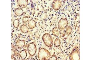 Immunohistochemistry of paraffin-embedded human gastric cancer using ABIN7160084 at dilution of 1:100 (BUB1 antibody  (AA 256-577))