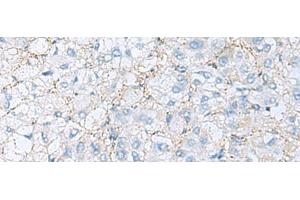Immunohistochemistry of paraffin-embedded Human liver cancer tissue using EMILIN1 Polyclonal Antibody at dilution of 1:70(x200) (Emilin1 antibody)