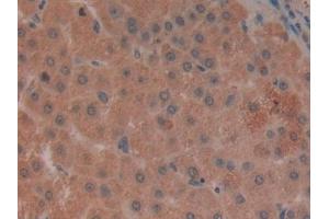 Detection of LILRB2 in Human Liver cancer Tissue using Polyclonal Antibody to Leukocyte Immunoglobulin Like Receptor Subfamily B, Member 2 (LILRB2) (LILRB2 antibody  (AA 53-255))