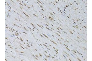 Immunohistochemistry of paraffin-embedded human uterine cancer using HDGFRP3 antibody (ABIN5995765) at dilution of 1/100 (40x lens). (HDGFRP3 antibody)